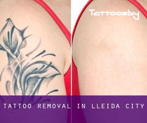 Tattoo Removal in Lleida (City)