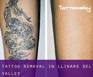 Tattoo Removal in Llinars del Vallès