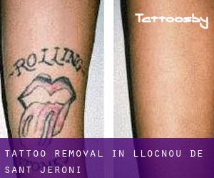 Tattoo Removal in Llocnou de Sant Jeroni