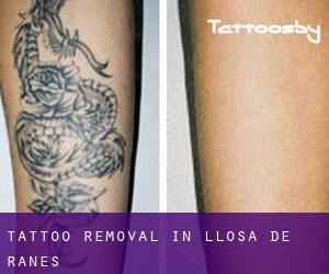 Tattoo Removal in Llosa de Ranes