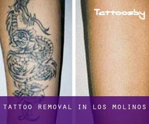 Tattoo Removal in Los Molinos