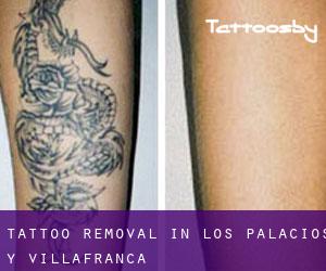 Tattoo Removal in Los Palacios y Villafranca