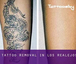 Tattoo Removal in Los Realejos