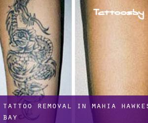 Tattoo Removal in Mahia (Hawke's Bay)
