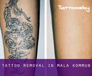 Tattoo Removal in Malå Kommun