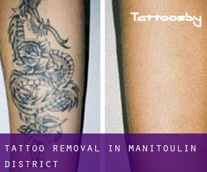 Tattoo Removal in Manitoulin District