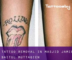 Tattoo Removal in Masjid Jamie Baitul Muttaqien