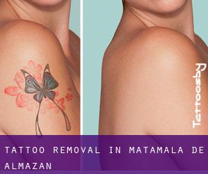 Tattoo Removal in Matamala de Almazán
