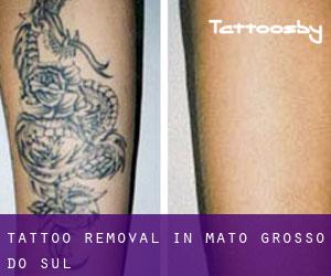 Tattoo Removal in Mato Grosso do Sul