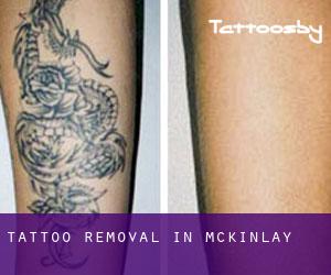 Tattoo Removal in McKinlay