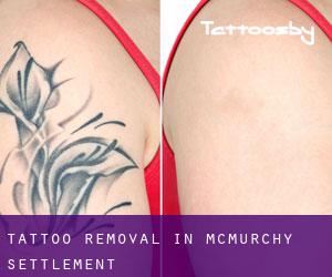 Tattoo Removal in McMurchy Settlement