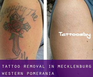Tattoo Removal in Mecklenburg-Western Pomerania