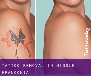 Tattoo Removal in Middle Franconia
