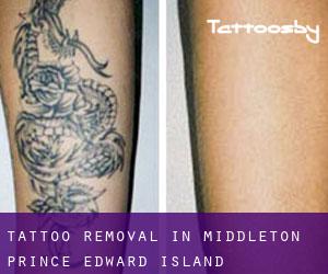 Tattoo Removal in Middleton (Prince Edward Island)