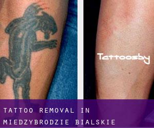 Tattoo Removal in Międzybrodzie Bialskie