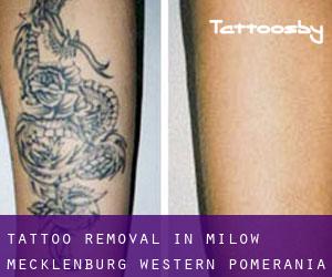 Tattoo Removal in Milow (Mecklenburg-Western Pomerania)