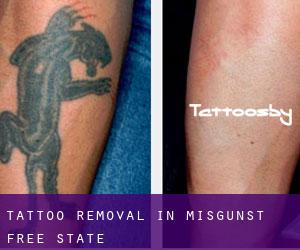 Tattoo Removal in Misgunst (Free State)