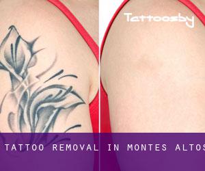 Tattoo Removal in Montes Altos
