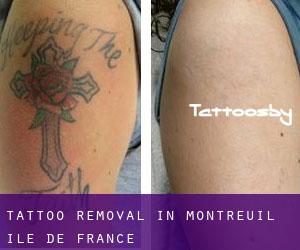 Tattoo Removal in Montreuil (Île-de-France)