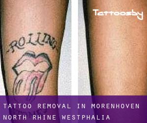 Tattoo Removal in Morenhoven (North Rhine-Westphalia)