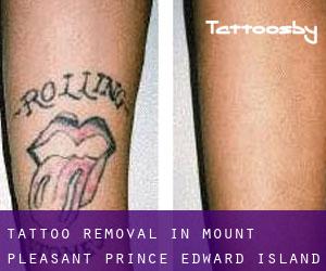 Tattoo Removal in Mount Pleasant (Prince Edward Island)