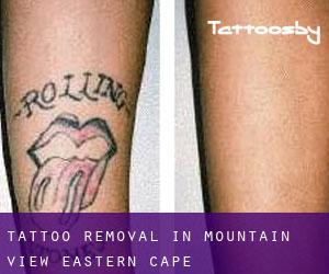 Tattoo Removal in Mountain View (Eastern Cape)