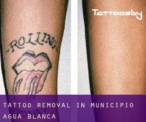 Tattoo Removal in Municipio Agua Blanca