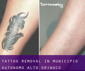Tattoo Removal in Municipio Autónomo Alto Orinoco