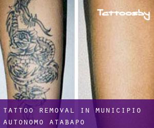 Tattoo Removal in Municipio Autónomo Atabapo