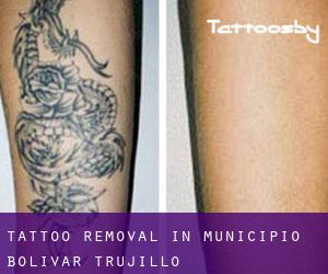 Tattoo Removal in Municipio Bolívar (Trujillo)