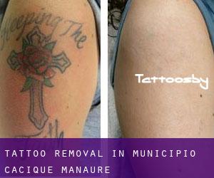 Tattoo Removal in Municipio Cacique Manaure