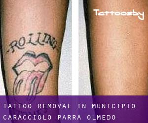 Tattoo Removal in Municipio Caracciolo Parra Olmedo