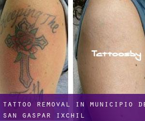 Tattoo Removal in Municipio de San Gaspar Ixchil