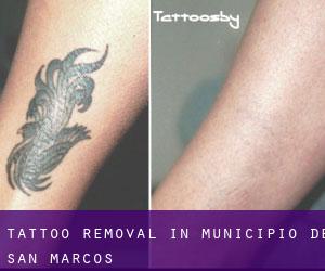 Tattoo Removal in Municipio de San Marcos