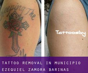 Tattoo Removal in Municipio Ezequiel Zamora (Barinas)