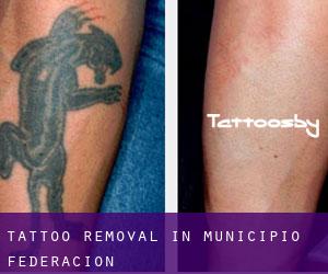 Tattoo Removal in Municipio Federación