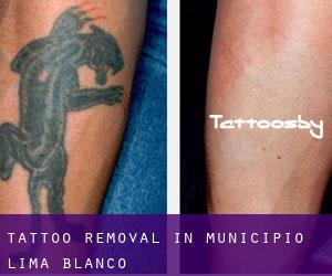 Tattoo Removal in Municipio Lima Blanco