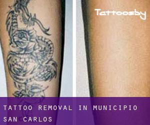 Tattoo Removal in Municipio San Carlos