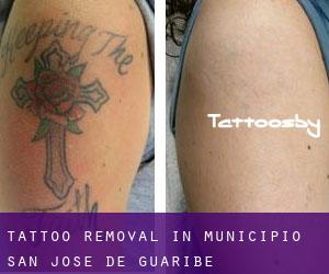 Tattoo Removal in Municipio San José de Guaribe