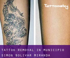 Tattoo Removal in Municipio Simón Bolívar (Miranda)