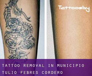 Tattoo Removal in Municipio Tulio Febres Cordero