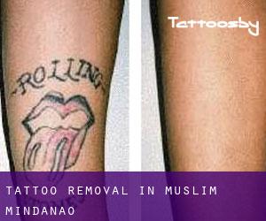 Tattoo Removal in Muslim Mindanao