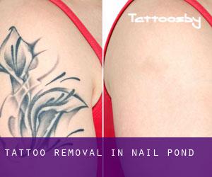 Tattoo Removal in Nail Pond