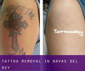 Tattoo Removal in Navas del Rey