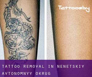 Tattoo Removal in Nenetskiy Avtonomnyy Okrug
