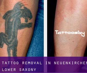 Tattoo Removal in Neuenkirchen (Lower Saxony)