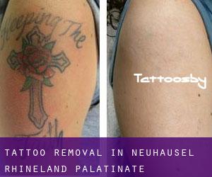 Tattoo Removal in Neuhäusel (Rhineland-Palatinate)