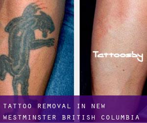 Tattoo Removal in New Westminster (British Columbia)