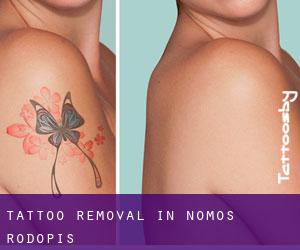 Tattoo Removal in Nomós Rodópis