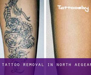 Tattoo Removal in North Aegean